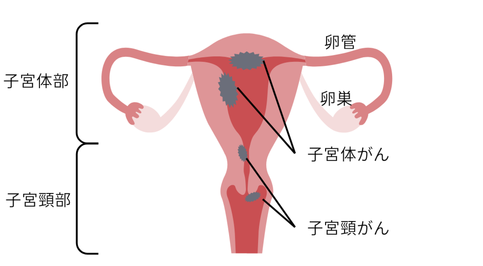 子宮体がんは子宮体部、子宮頸部にできた癌を指す旨を説明した図